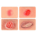 Pressure Ulcer Wound Models Pocket Size for Nursing Training, Pressure Wound Packing Trainer for Medical Education, Bedsore Wound Care Demonstrations Tool