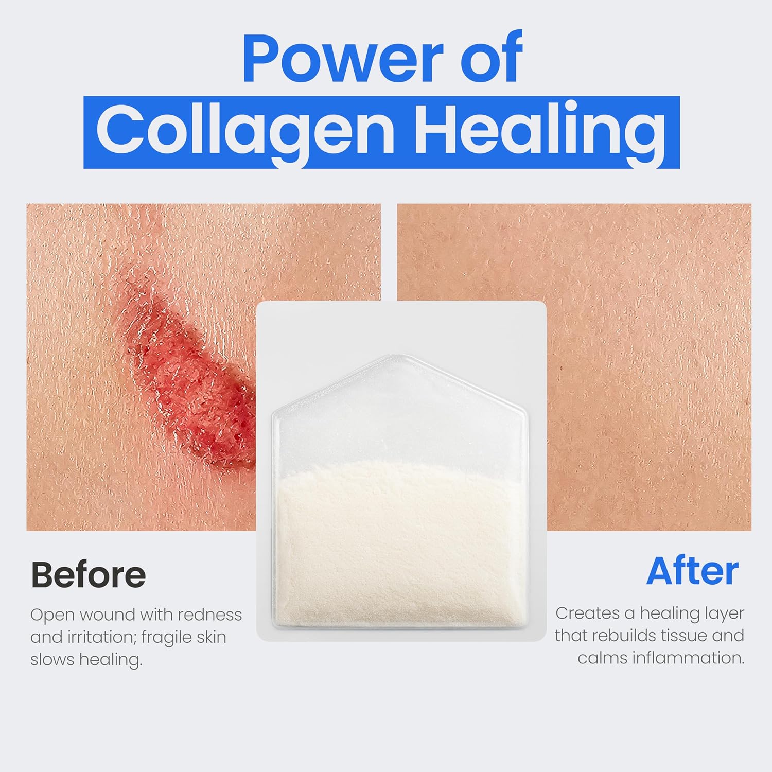 Collagen Dressing Powder for Wounds - 1g Packets - 10 Count - Medical Grade Bovine Collagen Powder Dressing for Wound Care, Non-Adherent Collagen Wound Dressing Supplies